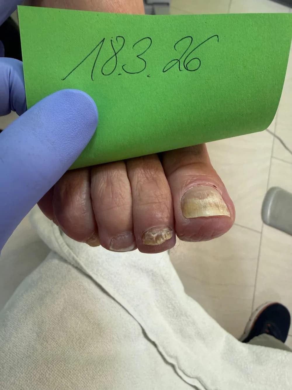 Nagelpilz an den Zehennägeln eines weiteren Patienten vor der Kaltplasmatherapie – verfärbt und brüchig