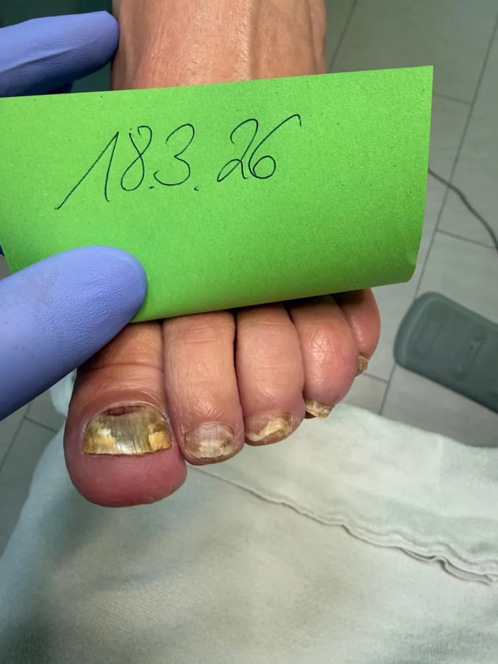 Nagelpilz an den Großzehennägeln vor der Kaltplasmatherapie – verfärbt und verdickt